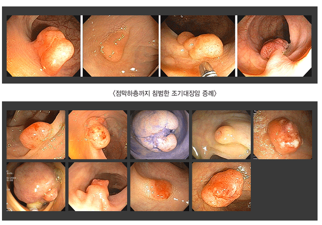 <점막하층까지 침범한 조기대장암 증례>