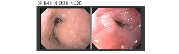 <위내시경 상 진단된 식도암>