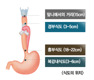 식도 구조 및 식도암 이미지