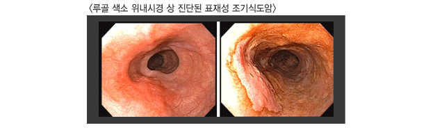 루골 색소 위내시경 상 진단된 표재성 조기식도암 이미지